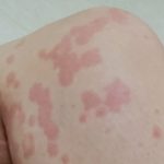 아나필락시스 피부