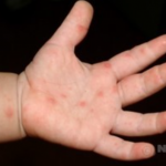 수족구에 걸린 후 손바닥