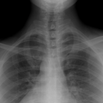 폐렴 확인을 위한 엑스레이 사진